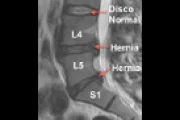 Lower back pain for kayakers hernia